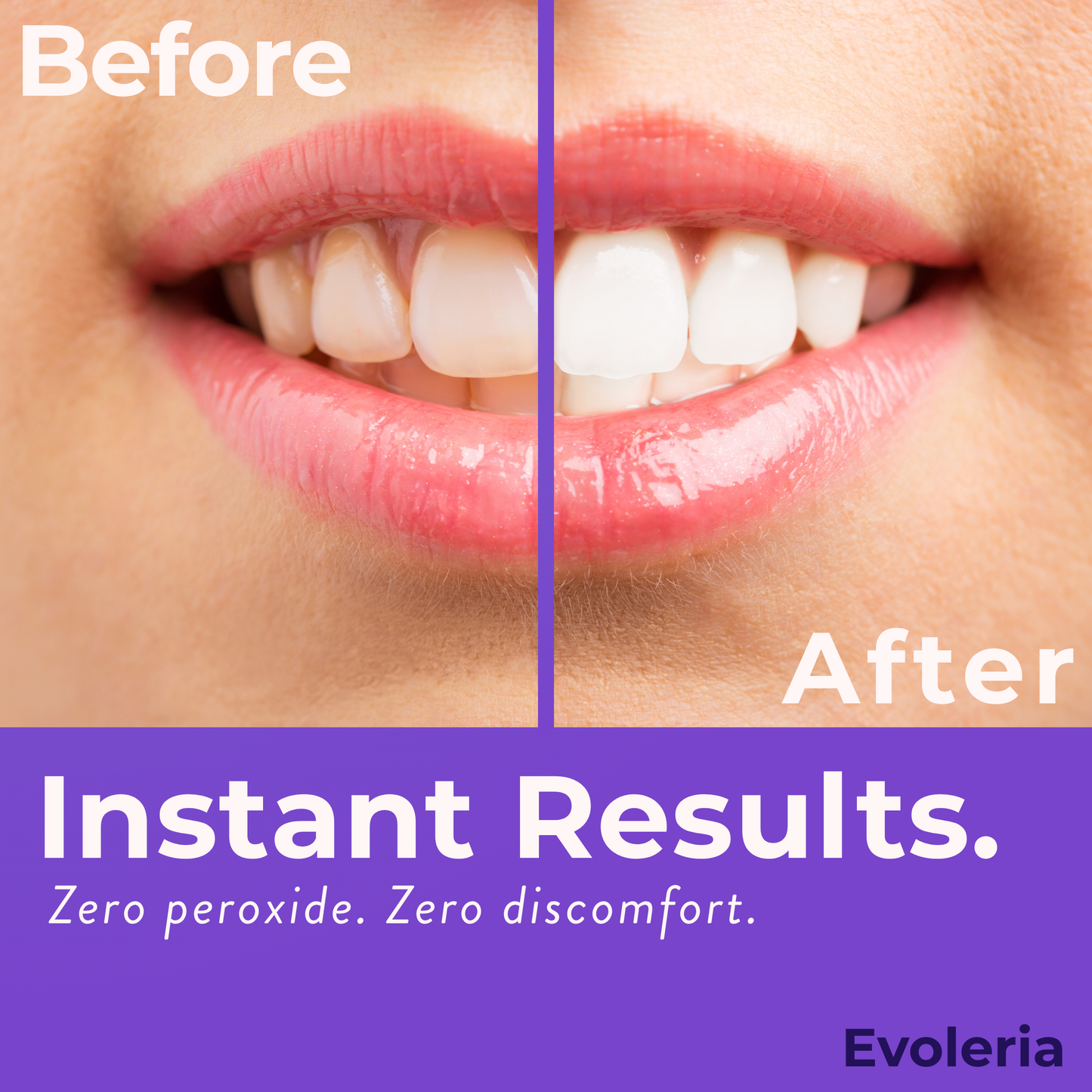 Evoleria V34 Teeth Whitening Strips